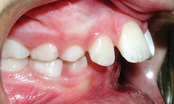 Upper Front Teeth Protrusion Treatment Embrace Orthodontics in Cibolo, TX